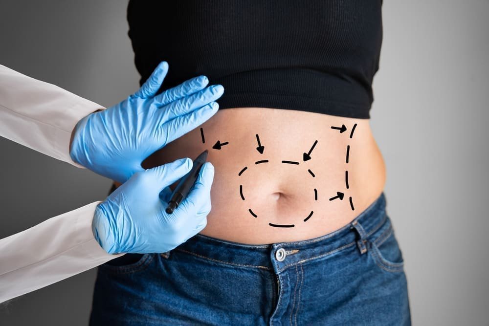 abdominal liposuction vs tummy tuck