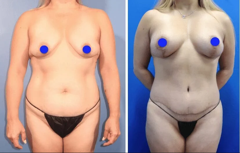 Before and after frontal view showing lifted, reshaped breasts and improved torso contour following lollipop breast lift at Pacific Sound Plastic Surgery.