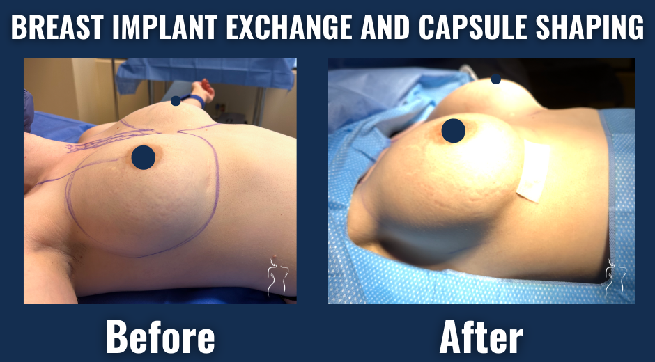 Before and after intraoperative photos of breast implant exchange with capsule shaping showing enhanced implant placement and breast contour.