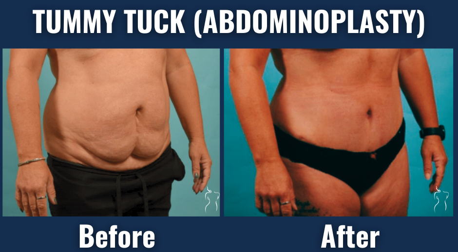 Before and after results of tummy tuck (abdominoplasty) showing removal of excess abdominal skin and improved waistline in a female patient.
