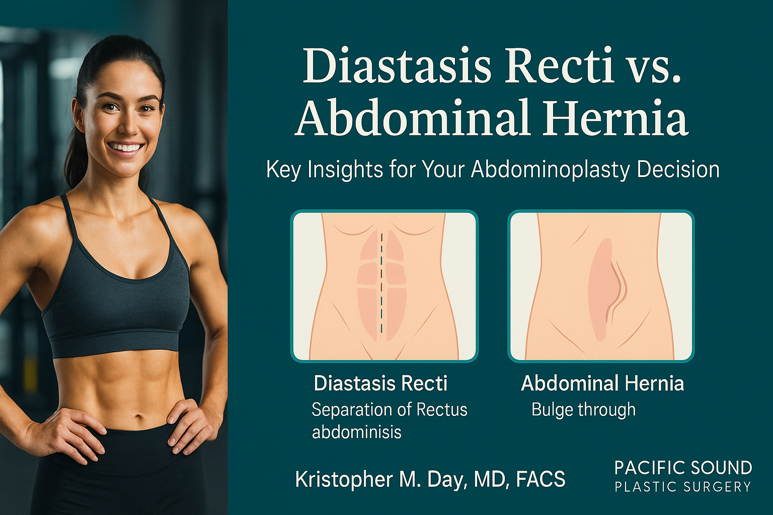 Infographic comparing diastasis recti (midline muscle separation) and abdominal hernia (fascial defect with tissue protrusion), with a fit woman at left and two abdominal diagrams at right.