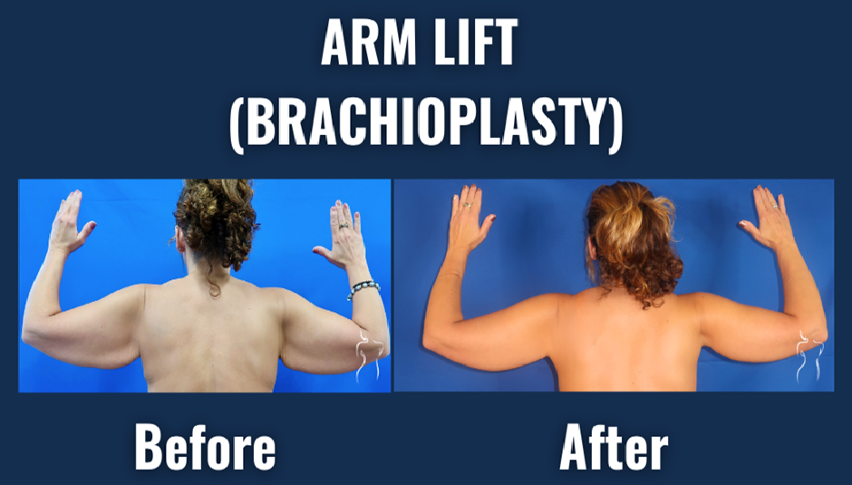 Before and after comparison of arm lift brachioplasty surgery showing back view of patient with raised arms - before image displays loose, sagging upper arm skin; after image shows tightened, contoured arms with reduced excess skin